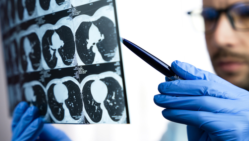 Ein Arzt betrachtet die Röntgenaufnahme einer Lunge.